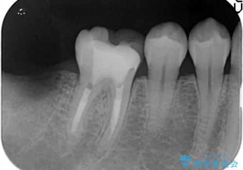 【オールセラミック】奥歯が痛い。根管治療〜被せ物治療の治療前
