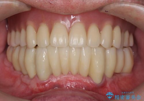 [ 重度歯周病 ] インプラント・義歯による咬合再構築の症例 治療後