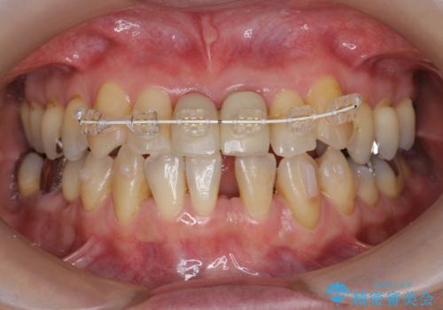 [ 矯正と補綴、総合歯科治療 ]  クロスバイトを避ける前歯部審美ブリッジの治療中