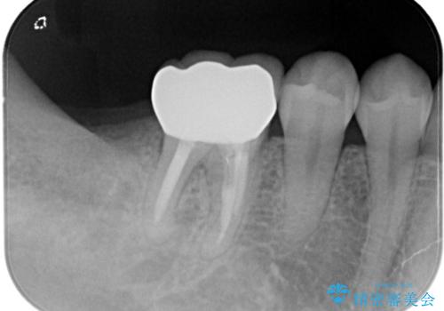 【オールセラミック】奥歯が痛い。根管治療〜被せ物治療の治療後