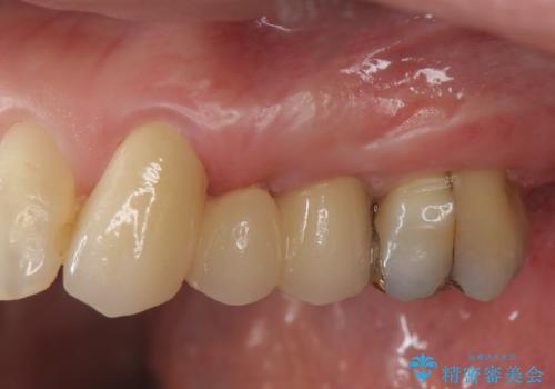 小矯正を伴う臼歯部ブリッジ治療の治療後