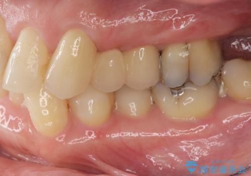 小矯正を伴う臼歯部ブリッジ治療の治療後