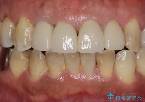 老朽化した前歯のクラウンやりかえの治療後