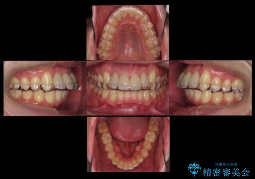 前歯のすき間 セラミックで綺麗に 最短で治療の治療後