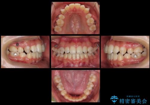 インビザラインチェンジで成功 インビザラインで八重歯の抜歯矯正の治療中