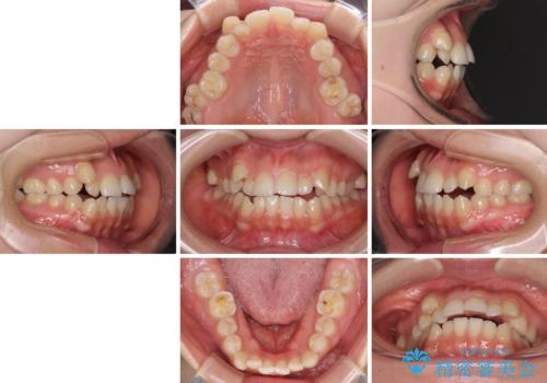 目立ちにくい抜歯矯正 ハーフリンガルの治療前