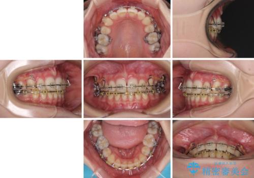 治療途中で転院 抜歯矯正の仕上げ治療の治療前