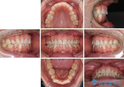 抜歯矯正の後戻りが気になる インビザライン・ライトによる矯正治療の治療前