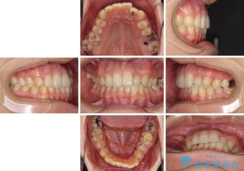 前歯のクロスバイトと抜歯が必要な奥歯の虫歯 インビザラインとインプラント治療の治療前