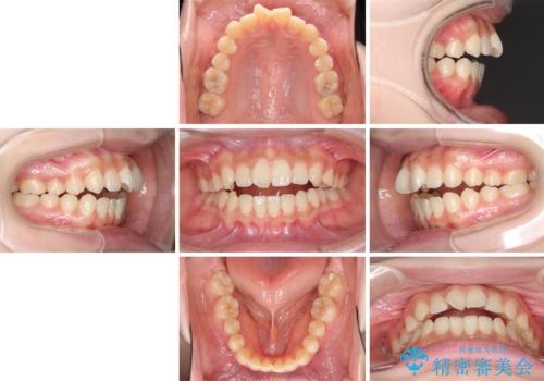 話しにくいオープンバイト ワイヤー装置による抜歯矯正治療の治療前
