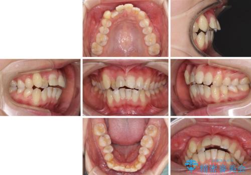 転んで前歯が欠けた 折れた前歯をきっかけに矯正治療で歯列をきれいに整えるの治療前