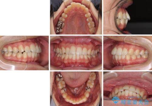 インビザライン・ライトによる矯正治療の後戻り改善の治療前