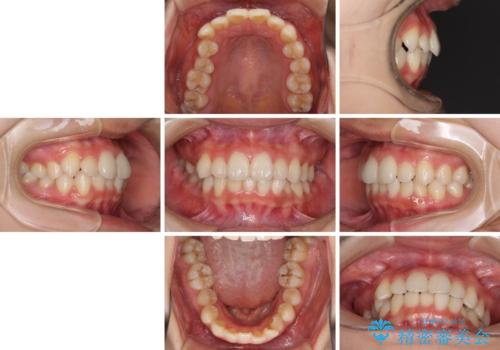 インビザラインを用いた非抜歯矯正の治療前