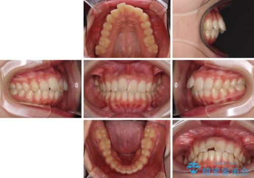 就職前にきれいな歯並びにしたい 大学生のインビザライン矯正の治療前