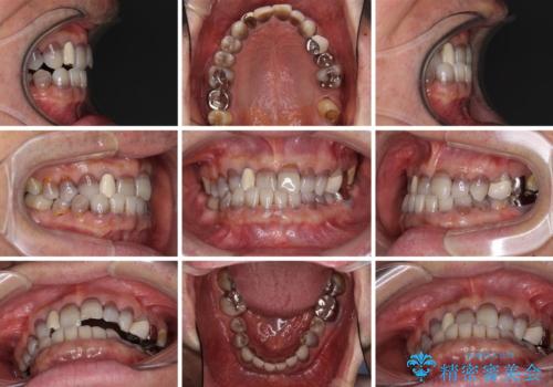 下の歯が前に出てしまう咬み合わせを治したい インビザラインによる矯正治療の治療前