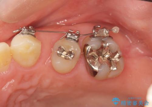 小矯正を伴う臼歯部ブリッジ治療の治療中