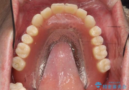 [ 重度歯周病 ] インプラント・義歯による咬合再構築の治療後