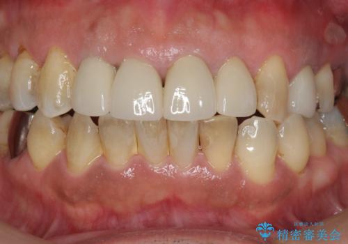 老朽化した前歯のクラウンやりかえの治療後