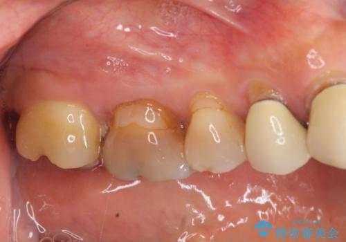 [ セラミック治療 ]歯の色が気になる　虫歯も治したいの症例 治療前