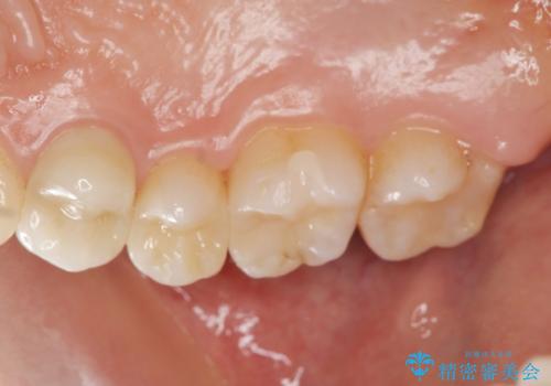 銀歯を白くしたい　隙間がしみるの症例 治療後