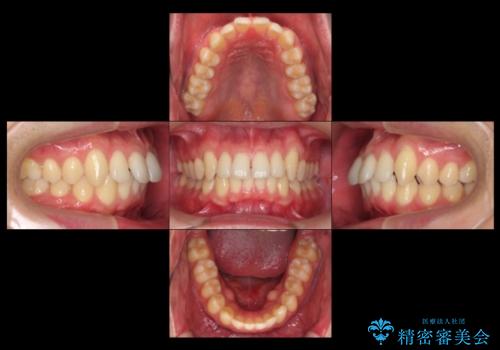 前歯のすき間 セラミックで綺麗に 最短で治療の治療前