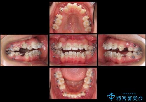 インビザラインチェンジで成功 インビザラインで八重歯の抜歯矯正の治療中