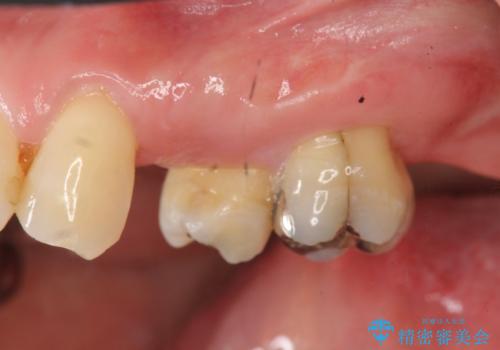 小矯正を伴う臼歯部ブリッジ治療の治療前