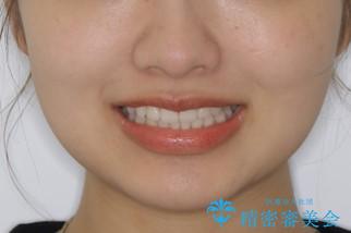 前歯のがたつきをインビザラインで治療の治療後(顔貌)