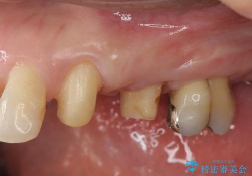 小矯正を伴う臼歯部ブリッジ治療の治療中