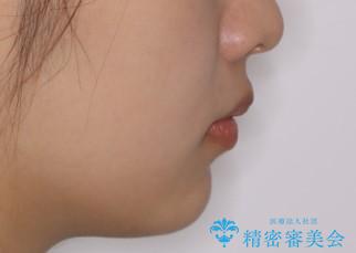 前歯のがたつきをインビザラインで治療の治療後(顔貌)