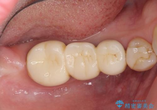 「ブリッジのところで噛むと痛い」 神経組織が原因の咬合痛の治療前