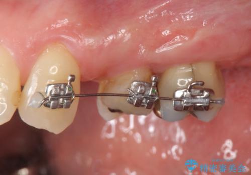 小矯正を伴う臼歯部ブリッジ治療の治療中