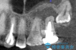 歯ぐきから出る膿　何度治療しても治らない　精密根管治療　50代男性