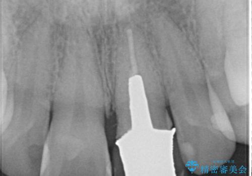 保険の被せ物をきれいにしたい オールセラミックの治療前