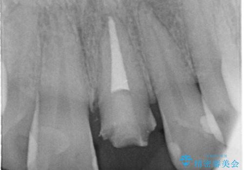 保険の被せ物をきれいにしたい オールセラミックの治療後