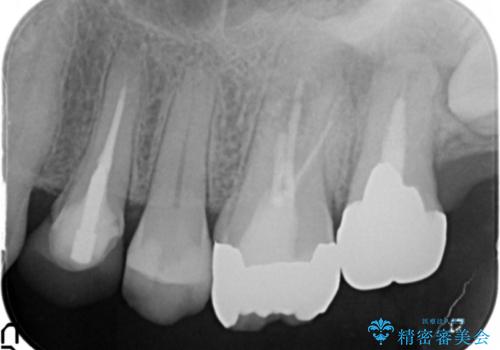歯ぐきから出る膿　何度治療しても治らない　精密根管治療　50代男性の症例 治療前