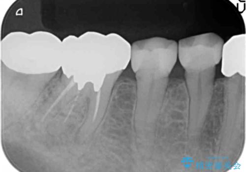 被せ物を入れたばかりの歯が痛む 40代女性の治療前