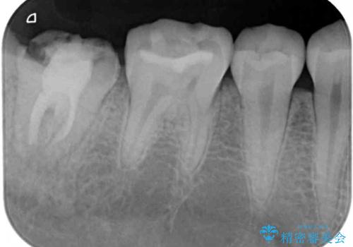 クラウンがすぐに外れてしまう 歯冠長延長術を用いた補綴治療の治療前