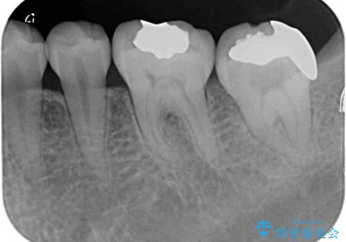 奥歯が痛い 保険治療後に症状が発現した歯のむし歯治療の治療前