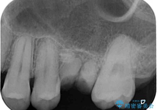 前歯のクロスバイトと抜歯が必要な奥歯の虫歯 インビザラインとインプラント治療の治療前