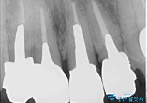 老朽化した前歯のクラウンやりかえの治療前