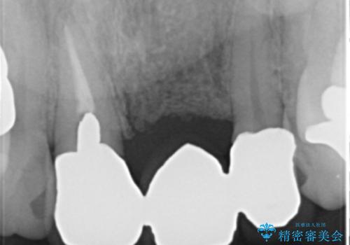 不自然なブリッジ 自然なセラミックでやりかえ 30代女性の治療前