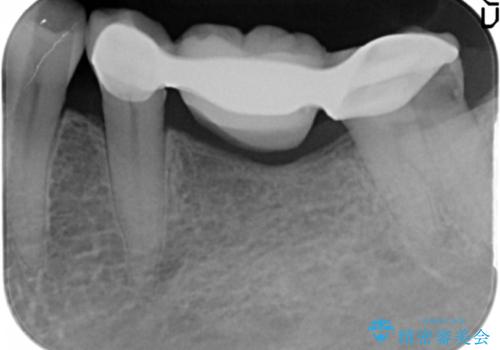歯が痛い 深いう蝕により神経が死んでいる 50代女性の治療前