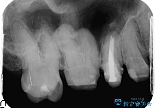 他院で仮歯まで入れたが違和感がある 40代女性の治療前