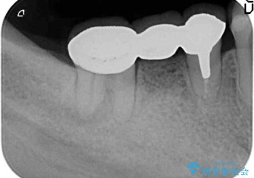 「ブリッジのところで噛むと痛い」 神経組織が原因の咬合痛の治療前