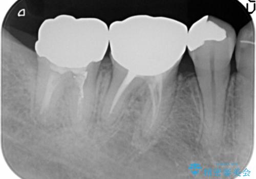 低予算で銀歯を白くしたい 50代女性の治療前