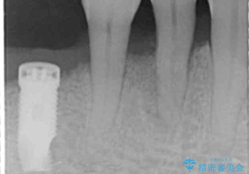 歯がぐらぐら 再生療法で抜かずに残す 50代男性の治療中