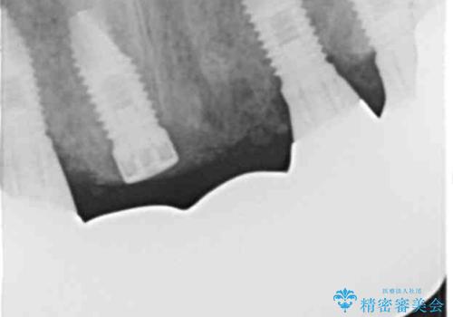 喫煙を再開してインプラント周囲炎に リカバリー治療 50代男性の治療後