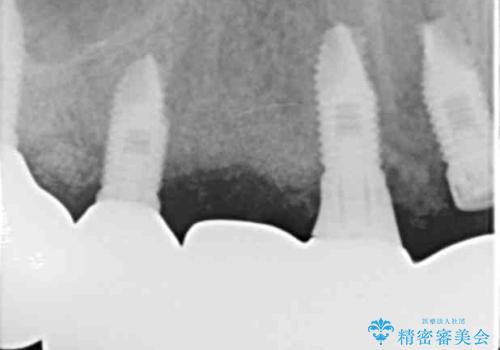 喫煙を再開してインプラント周囲炎に リカバリー治療 50代男性の治療後