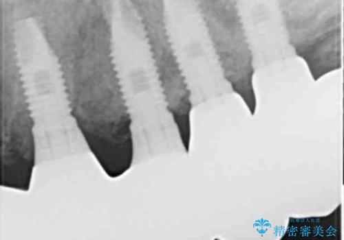喫煙を再開してインプラント周囲炎に リカバリー治療 50代男性の治療後